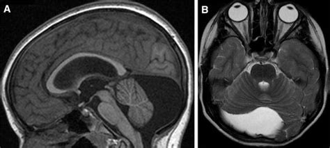 Retrocerebellar arachnoid cyst .